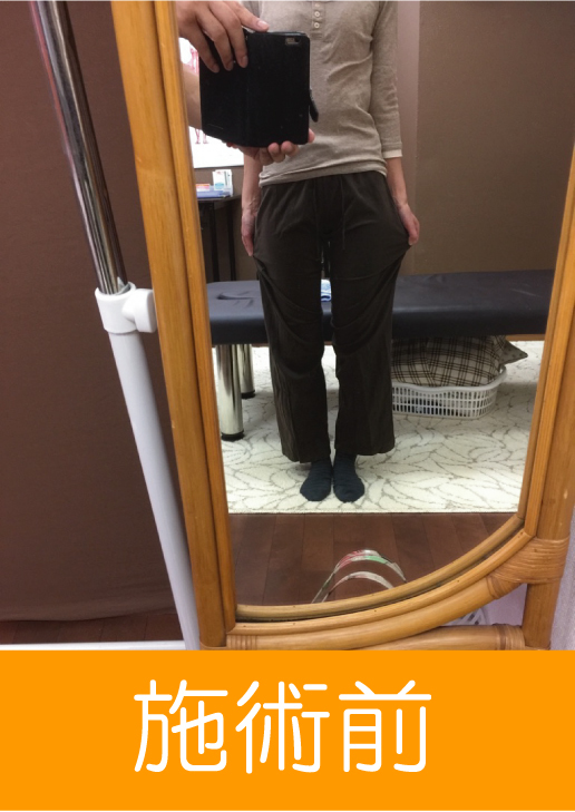 O脚施術前