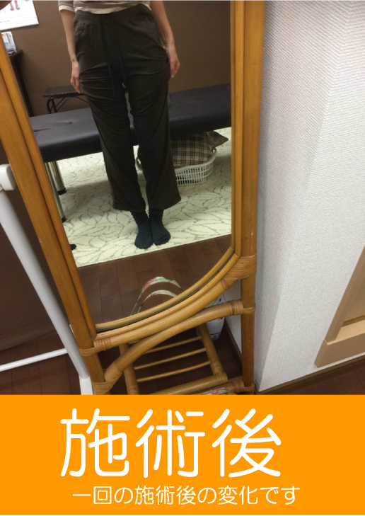 O脚施術後